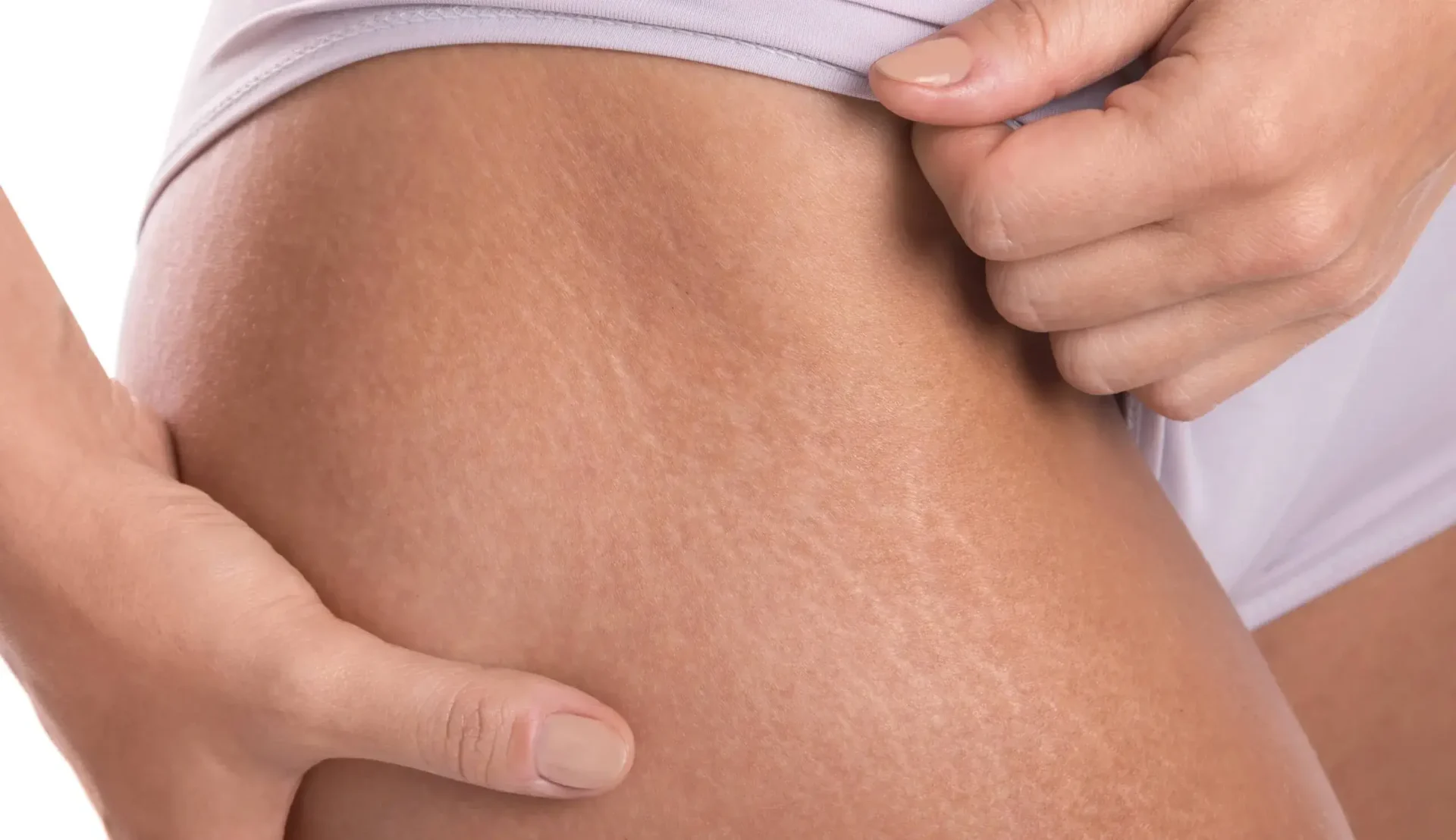 Stretch Mark and Scar Camouflage Clinic